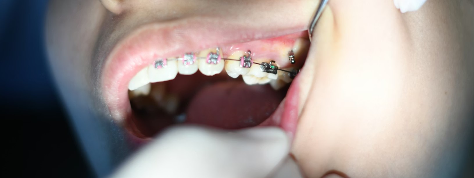 metal braces being applied in lansing mi