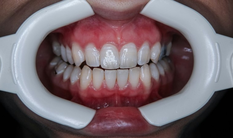 teeth whitening professional lansing mi