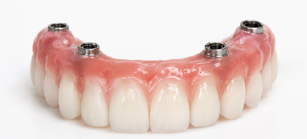 all on 4 dental implant
