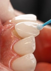veneers in lansing