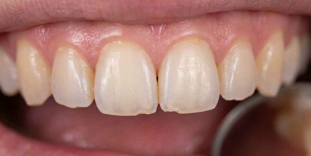 teeth with enamel wear